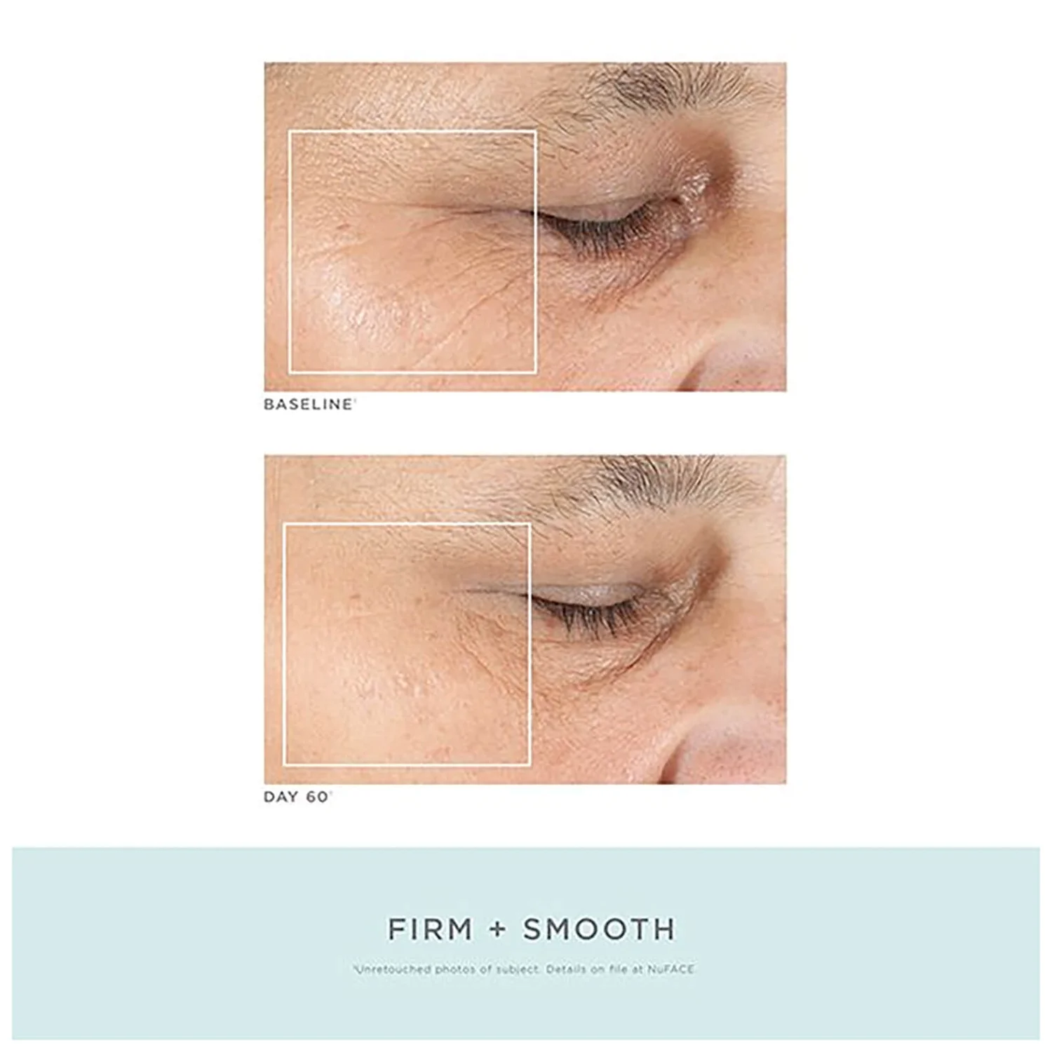 NuFACE Trinity ELE Attachment (1 Piece) 2 NuFACE Trinity ELE Attachment (1 Piece) - Image 2